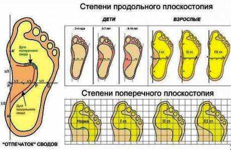 ploskostopiye_ispravleniye