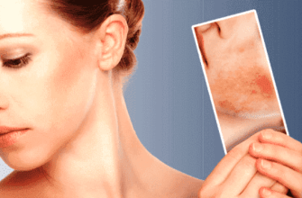 dermatit 5 spasitelnyh domashnih sredstv