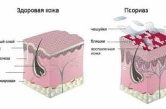 psoriaz