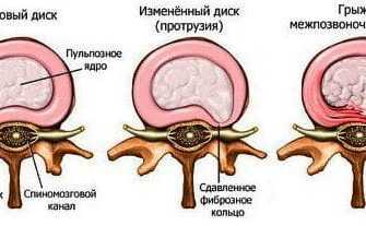 protruziya