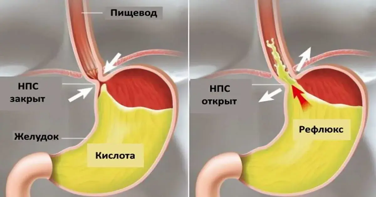 gastroezofagealnaya-reflyuksnaya-bolezn